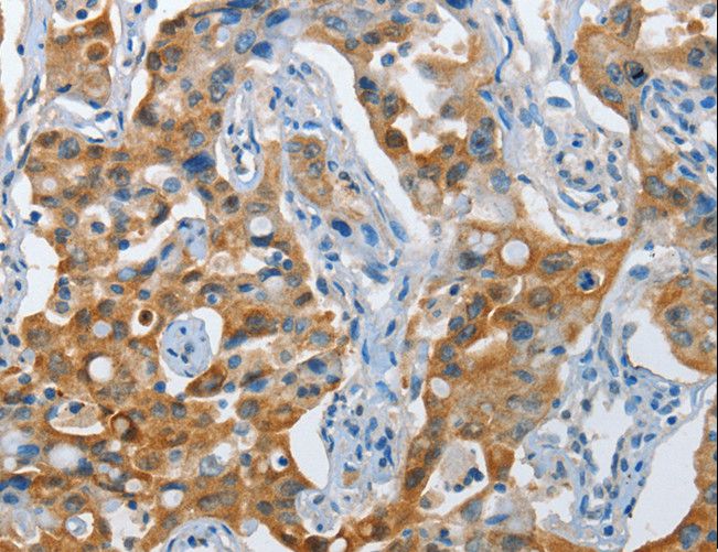 NOL3 / ARC Antibody - Immunohistochemistry of paraffin-embedded Human lung cancer using NOL3 Polyclonal Antibody at dilution of 1:35.