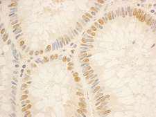 NOL5A / NOP56 Antibody - Detection of Human NOP56 by Immunohistochemistry. Sample: FFPE section of human colon carcinoma. Antibody: Affinity purified rabbit anti-NOP56 used at a dilution of 1:1000 (0.2 ug/ml). Detection: DAB.