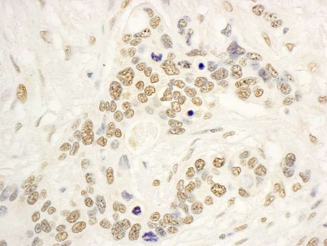 NOL8 Antibody - Detection of Human NOP132 by Immunohistochemistry. Sample: FFPE section of human ovarian carcinoma. Antibody: Affinity purified rabbit anti-NOP132 used at a dilution of 1:5000 (0.2 ug/ml). Detection: DAB.