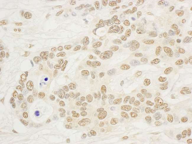 NOL8 Antibody - Detection of Human NOP132 by Immunohistochemistry. Sample: FFPE section of human ovarian carcinoma. Antibody: Affinity purified rabbit anti-NOP132 used at a dilution of 1:1000 (1 ug/ml). Detection: DAB.