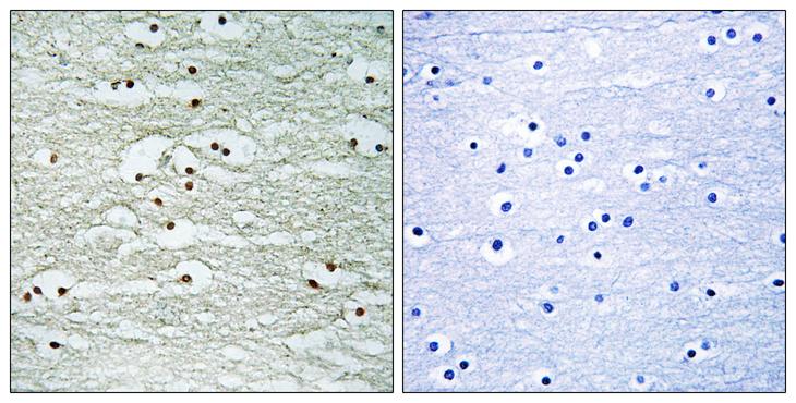 NOL8 Antibody - Peptide - + Immunohistochemistry analysis of paraffin-embedded human breast carcinoma tissue, using NOL8 antibody.