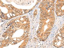 NOL8 Antibody - Immunohistochemistry of paraffin-embedded Human gastric cancer tissue  using NOL8 Polyclonal Antibody at dilution of 1:40(×200)