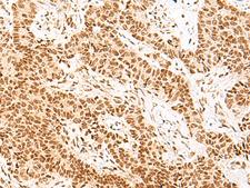 NOLA2 Antibody - Immunohistochemistry of paraffin-embedded Human ovarian cancer tissue  using NHP2 Polyclonal Antibody at dilution of 1:55(×200)