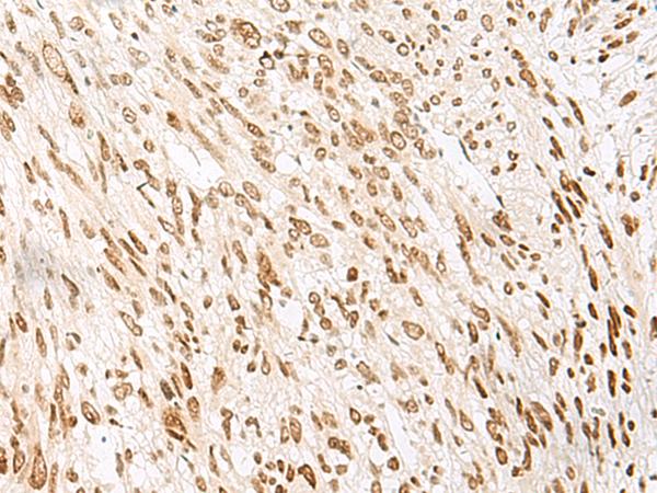 NOLA2 Antibody - Immunohistochemistry of paraffin-embedded Human liver cancer tissue  using NHP2 Polyclonal Antibody at dilution of 1:55(×200)