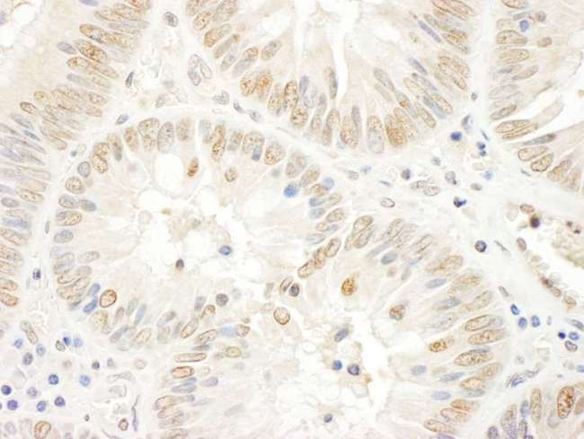 NOLC1 Antibody - Detection of Human NOPP140 by Immunohistochemistry. Sample: FFPE section of human colon carcinoma. Antibody: Affinity purified rabbit anti-NOPP140 used at a dilution of 1:1000 (1 ug/ml). Detection: DAB.