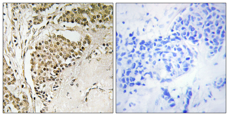 NOM1 Antibody - Immunohistochemistry analysis of paraffin-embedded human breast carcinoma tissue, using NOM1 Antibody. The picture on the right is blocked with the synthesized peptide.