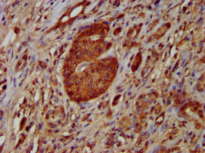 NOMO1 / PM5 Antibody - Immunohistochemistry image at a dilution of 1:100 and staining in paraffin-embedded human pancreatic cancer performed on a Leica BondTM system. After dewaxing and hydration, antigen retrieval was mediated by high pressure in a citrate buffer (pH 6.0) . Section was blocked with 10% normal goat serum 30min at RT. Then primary antibody (1% BSA) was incubated at 4 °C overnight. The primary is detected by a biotinylated secondary antibody and visualized using an HRP conjugated SP system.