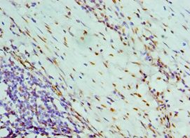 NONO / P54NRB Antibody - Immunohistochemistry of paraffin-embedded human colon cancer using antibody at 1:100 dilution.