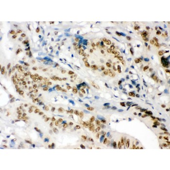 NONO / P54NRB Antibody - nmt55/p54nrb was detected in paraffin-embedded sections of human intestinal cancer tissues using rabbit anti- nmt55/p54nrb Antigen Affinity purified polyclonal antibody at 1 ug/mL. The immunohistochemical section was developed using SABC method.