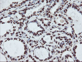 NONO / P54NRB Antibody - IHC of paraffin-embedded Adenocarcinoma of Human breast tissue using anti-NONO mouse monoclonal antibody.
