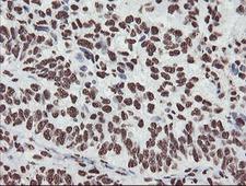 NONO / P54NRB Antibody - IHC of paraffin-embedded Adenocarcinoma of Human ovary tissue using anti-NONO mouse monoclonal antibody.