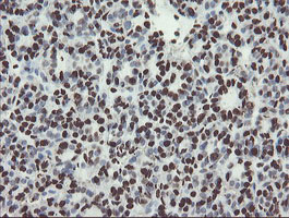 NONO / P54NRB Antibody - IHC of paraffin-embedded Carcinoma of Human thyroid tissue using anti-NONO mouse monoclonal antibody.
