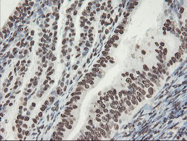 NONO / P54NRB Antibody - IHC of paraffin-embedded Adenocarcinoma of Human endometrium tissue using anti-NONO mouse monoclonal antibody.