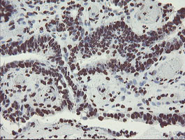 NONO / P54NRB Antibody - IHC of paraffin-embedded Adenocarcinoma of Human colon tissue using anti-NONO mouse monoclonal antibody. (Heat-induced epitope retrieval by 10mM citric buffer, pH6.0, 100C for 10min).