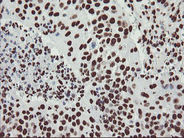 NONO / P54NRB Antibody - IHC of paraffin-embedded Carcinoma of Human lung tissue using anti-NONO mouse monoclonal antibody. (Heat-induced epitope retrieval by 10mM citric buffer, pH6.0, 100C for 10min).