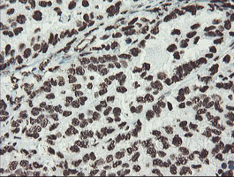 NONO / P54NRB Antibody - IHC of paraffin-embedded Adenocarcinoma of Human ovary tissue using anti-NONO mouse monoclonal antibody. (Heat-induced epitope retrieval by 10mM citric buffer, pH6.0, 100C for 10min).