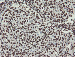 NONO / P54NRB Antibody - IHC of paraffin-embedded Carcinoma of Human bladder tissue using anti-NONO mouse monoclonal antibody.
