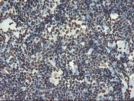 NONO / P54NRB Antibody - IHC of paraffin-embedded Human lymphoma tissue using anti-NONO mouse monoclonal antibody.