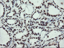 NONO / P54NRB Antibody - IHC of paraffin-embedded Adenocarcinoma of Human breast tissue using anti-NONO mouse monoclonal antibody.