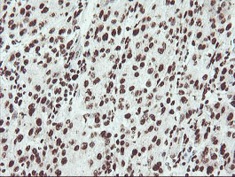 NONO / P54NRB Antibody - IHC of paraffin-embedded Carcinoma of Human liver tissue using anti-NONO mouse monoclonal antibody.