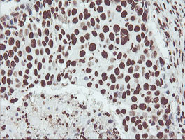 NONO / P54NRB Antibody - IHC of paraffin-embedded Carcinoma of Human lung tissue using anti-NONO mouse monoclonal antibody.