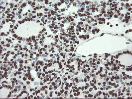 NONO / P54NRB Antibody - IHC of paraffin-embedded Carcinoma of Human thyroid tissue using anti-NONO mouse monoclonal antibody.