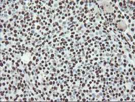 NONO / P54NRB Antibody - IHC of paraffin-embedded Carcinoma of Human bladder tissue using anti-NONO mouse monoclonal antibody.