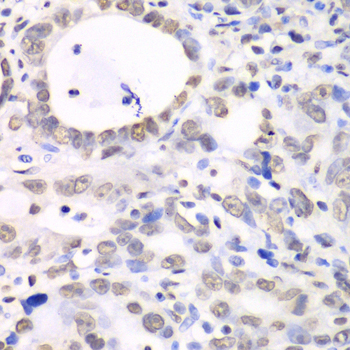 NONO / P54NRB Antibody - Immunohistochemistry of paraffin-embedded human gastric cancer tissue.
