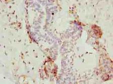 NOP10 Antibody - Immunohistochemistry of paraffin-embedded human breast cancer using antibody at dilution of 1:100.