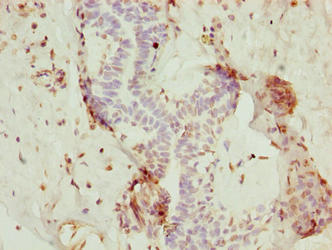 NOP10 Antibody - Immunohistochemistry of paraffin-embedded human breast cancer using NOP10 Antibody at dilution of 1:100