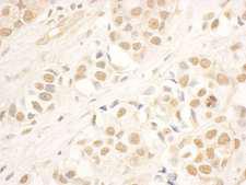 NOP58 / NOP5 Antibody - Detection of Human NOP58 by Immunohistochemistry. Sample: FFPE section of human breast carcinoma. Antibody: Affinity purified rabbit anti-NOP58 used at a dilution of 1:5000 (0.2 ug/ml). Detection: DAB.