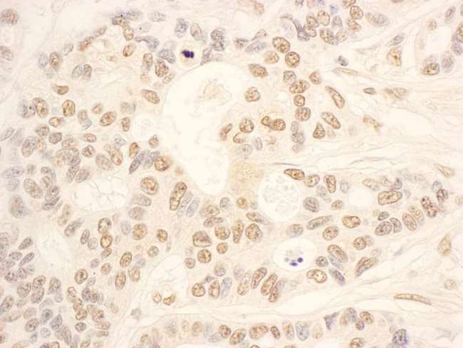 NOP58 / NOP5 Antibody - Detection of Human NOP58 by Immunohistochemistry. Sample: FFPE section of human ovarian carcinoma. Antibody: Affinity purified rabbit anti-NOP58 used at a dilution of 1:1000 (0.2 ug/ml). Detection: DAB.