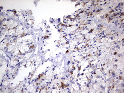 Nor-1 / NR4A3 Antibody - Immunohistochemical staining of paraffin-embedded Carcinoma of Human thyroid tissue using anti-NR4A3 mouse monoclonal antibody. (Heat-induced epitope retrieval by 1 mM EDTA in 10mM Tris, pH8.5, 120C for 3min,