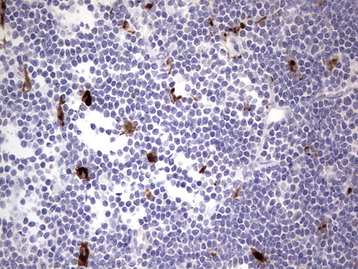 Nor-1 / NR4A3 Antibody - Immunohistochemical staining of paraffin-embedded Human lymphoma tissue using anti-NR4A3 mouse monoclonal antibody. (Heat-induced epitope retrieval by 1 mM EDTA in 10mM Tris, pH8.5, 120C for 3min,