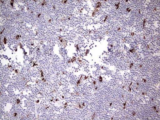 Nor-1 / NR4A3 Antibody - Immunohistochemical staining of paraffin-embedded Human lymphoma tissue using anti-NR4A3 mouse monoclonal antibody. (Heat-induced epitope retrieval by 1 mM EDTA in 10mM Tris, pH8.5, 120C for 3min,