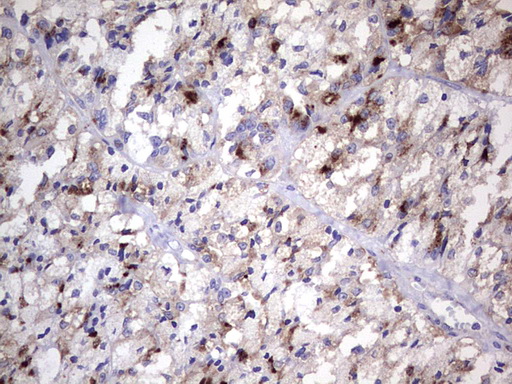 Nor-1 / NR4A3 Antibody - IHC of paraffin-embedded Carcinoma of Human thyroid tissue using anti-NR4A3 mouse monoclonal antibody. (Heat-induced epitope retrieval by 1 mM EDTA in 10mM Tris, pH8.5, 120°C for 3min).