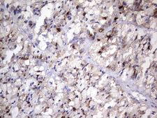 Nor-1 / NR4A3 Antibody - IHC of paraffin-embedded Carcinoma of Human thyroid tissue using anti-NR4A3 mouse monoclonal antibody. (Heat-induced epitope retrieval by 1 mM EDTA in 10mM Tris, pH8.5, 120°C for 3min).