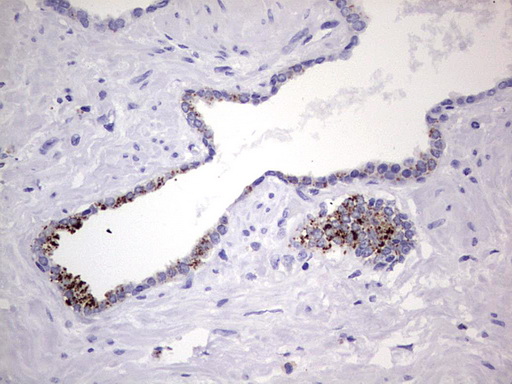 Nor-1 / NR4A3 Antibody - Immunohistochemical staining of paraffin-embedded Carcinoma of Human prostate tissue using anti-NR4A3 mouse monoclonal antibody. (Heat-induced epitope retrieval by 1 mM EDTA in 10mM Tris, pH8.5, 120C for 3min,