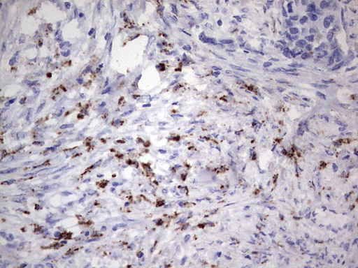 Nor-1 / NR4A3 Antibody - Immunohistochemical staining of paraffin-embedded Carcinoma of Human kidney tissue using anti-NR4A3 mouse monoclonal antibody. (Heat-induced epitope retrieval by 1 mM EDTA in 10mM Tris, pH8.5, 120C for 3min,