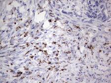Nor-1 / NR4A3 Antibody - IHC of paraffin-embedded Carcinoma of Human kidney tissue using anti-NR4A3 mouse monoclonal antibody. (Heat-induced epitope retrieval by 1 mM EDTA in 10mM Tris, pH8.5, 120°C for 3min).