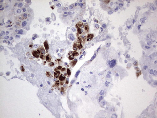 Nor-1 / NR4A3 Antibody - IHC of paraffin-embedded Adenocarcinoma of Human ovary tissue using anti-NR4A3 mouse monoclonal antibody. (Heat-induced epitope retrieval by 1 mM EDTA in 10mM Tris, pH8.5, 120°C for 3min).