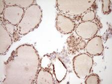 Nor-1 / NR4A3 Antibody - Immunohistochemical staining of paraffin-embedded Human thyroid tissue within the normal limits using anti-NR4A3 mouse monoclonal antibody. (Heat-induced epitope retrieval by Tris-EDTA, pH8.0) Dilution: 1:150