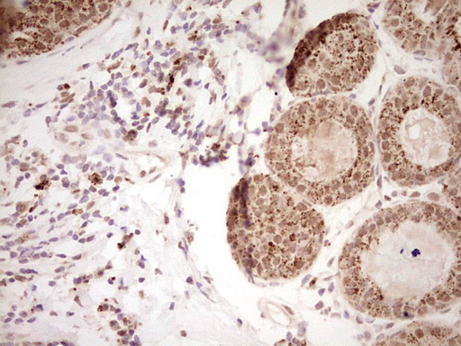 Nor-1 / NR4A3 Antibody - Immunohistochemical staining of paraffin-embedded Adenocarcinoma of Human breast tissue using anti-NR4A3 mouse monoclonal antibody. (Heat-induced epitope retrieval by Tris-EDTA, pH8.0) Dilution: 1:150