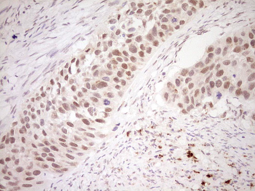 Nor-1 / NR4A3 Antibody - Immunohistochemical staining of paraffin-embedded Carcinoma of Human kidney tissue using anti-NR4A3 mouse monoclonal antibody. (Heat-induced epitope retrieval by Tris-EDTA, pH8.0) Dilution: 1:150