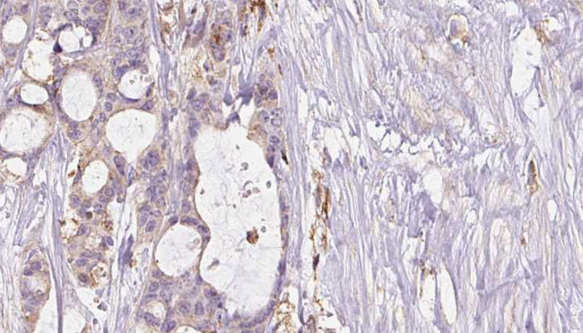 NOS1 / nNOS Antibody - 1:100 staining human liver carcinoma tissues by IHC-P. The sample was formaldehyde fixed and a heat mediated antigen retrieval step in citrate buffer was performed. The sample was then blocked and incubated with the antibody for 1.5 hours at 22°C. An HRP conjugated goat anti-rabbit antibody was used as the secondary.