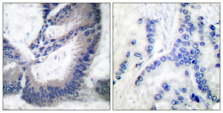 NOS2 / iNOS Antibody - Immunohistochemistry analysis of paraffin-embedded human lung carcinoma tissue, using iNOS Antibody. The picture on the right is blocked with the synthesized peptide.