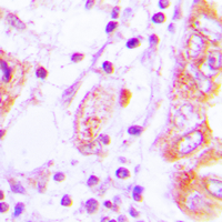 NOS2 / iNOS Antibody - Immunohistochemical analysis of iNOS staining in human lung cancer formalin fixed paraffin embedded tissue section. The section was pre-treated using heat mediated antigen retrieval with sodium citrate buffer (pH 6.0). The section was then incubated with the antibody at room temperature and detected using an HRP conjugated compact polymer system. DAB was used as the chromogen. The section was then counterstained with hematoxylin and mounted with DPX.