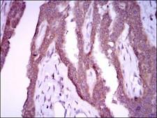 NOS2 / iNOS Antibody - Immunohistochemistry-Paraffin: iNOS Antibody (4E5) - Immunohistochemical analysis of paraffin-embedded breast cancer tissues using iNOS mouse mAb with DAB staining.