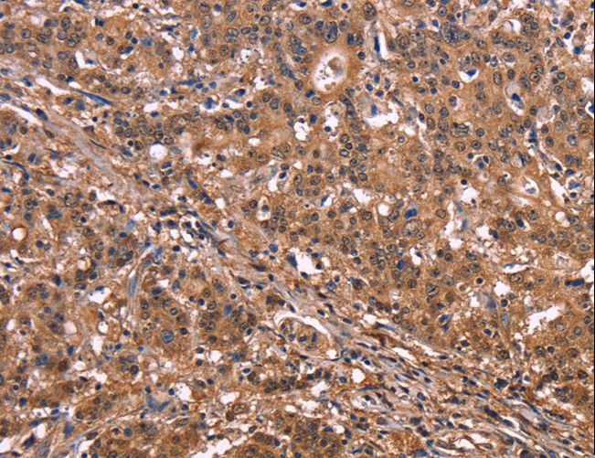 NOS2 / iNOS Antibody - Immunohistochemistry of paraffin-embedded Human liver cancer using NOS2 Polyclonal Antibody at dilution of 1:40.