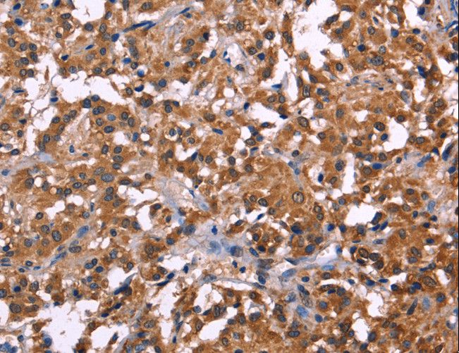 NOS2 / iNOS Antibody - Immunohistochemistry of paraffin-embedded Human gastric cancer using NOS2 Polyclonal Antibody at dilution of 1:30.